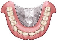 金属床義歯
