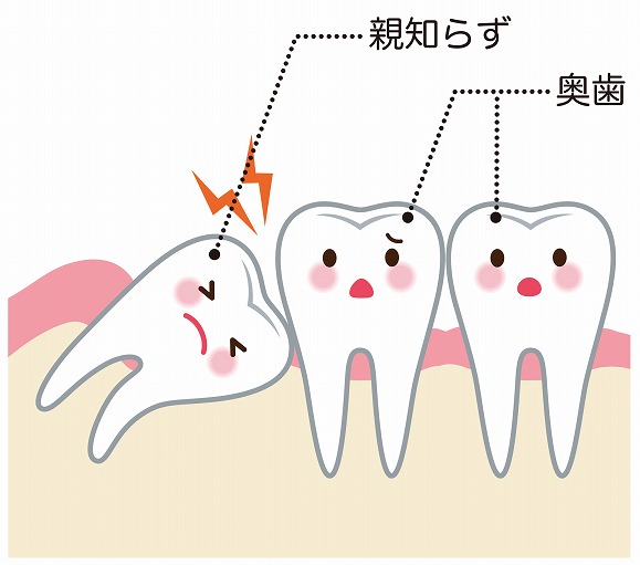 親知らずの隣の歯が虫歯になってしまう