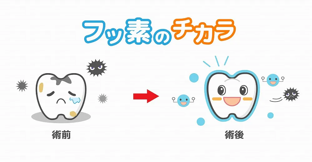 乳歯が生え揃ってきたらフッ素塗布