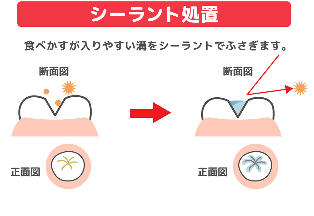 奥歯に6歳臼歯が生えてきたらシーラント