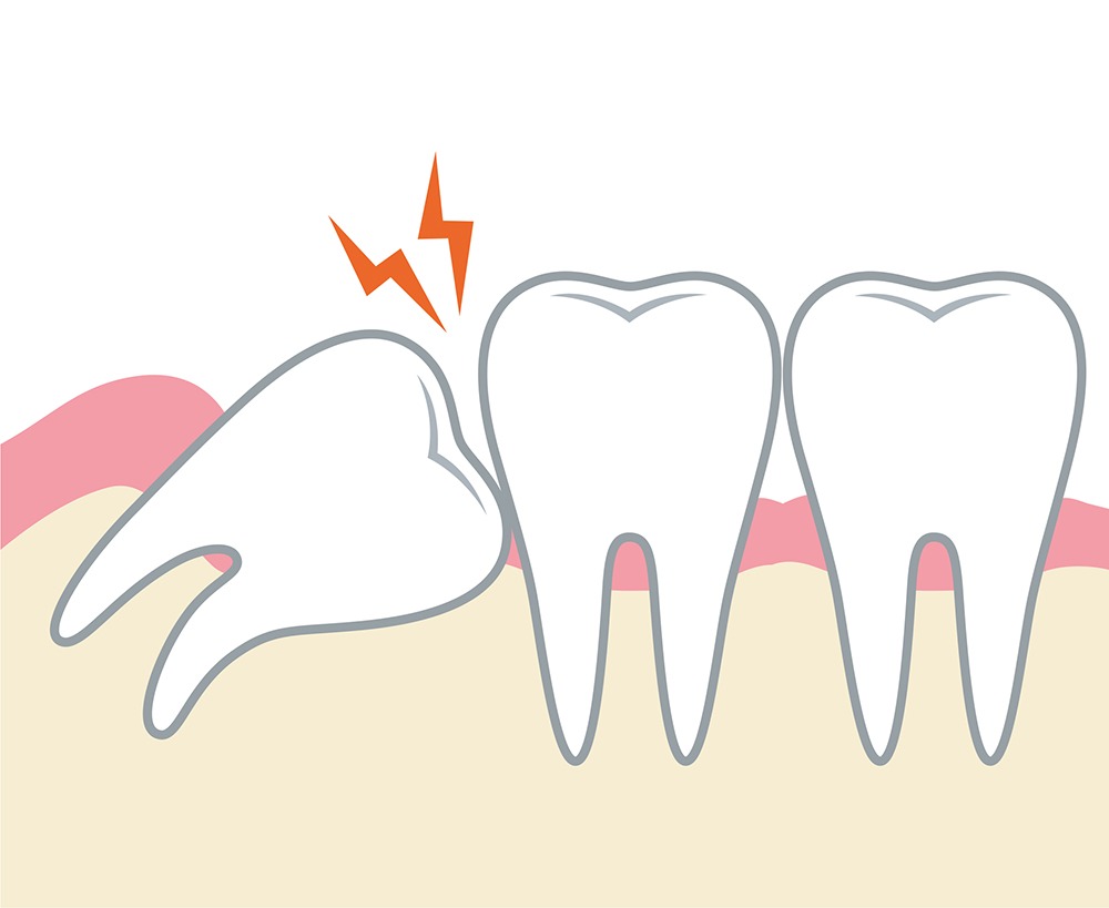 難症例の親知らずの治療も可能です