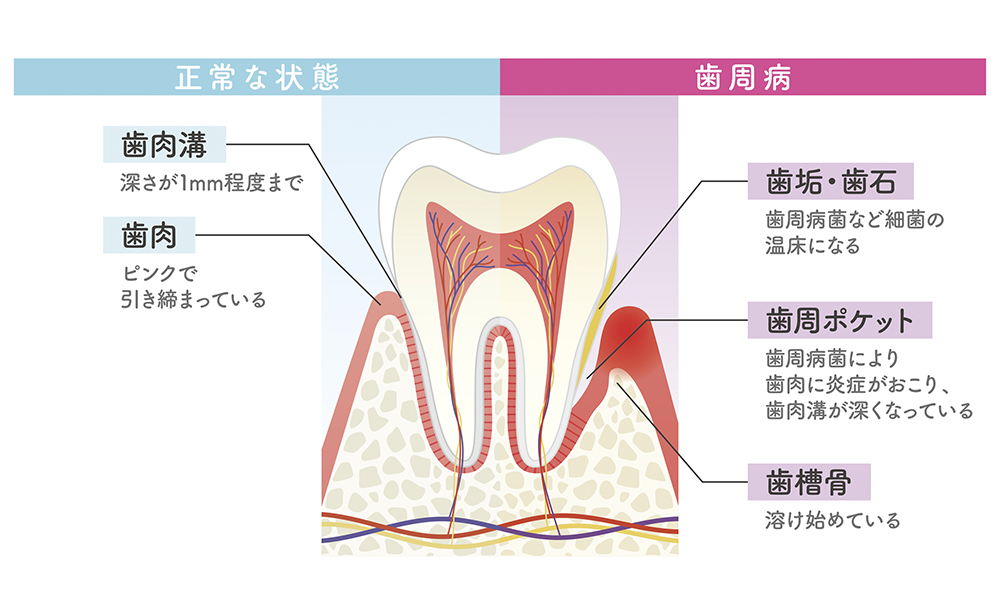 歯周病になる原因とは?