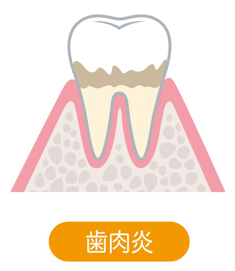 歯肉炎