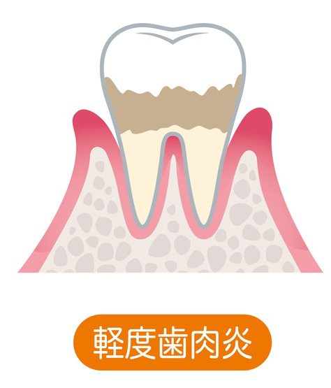 軽度歯周炎