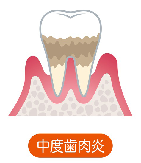 中等度歯周炎