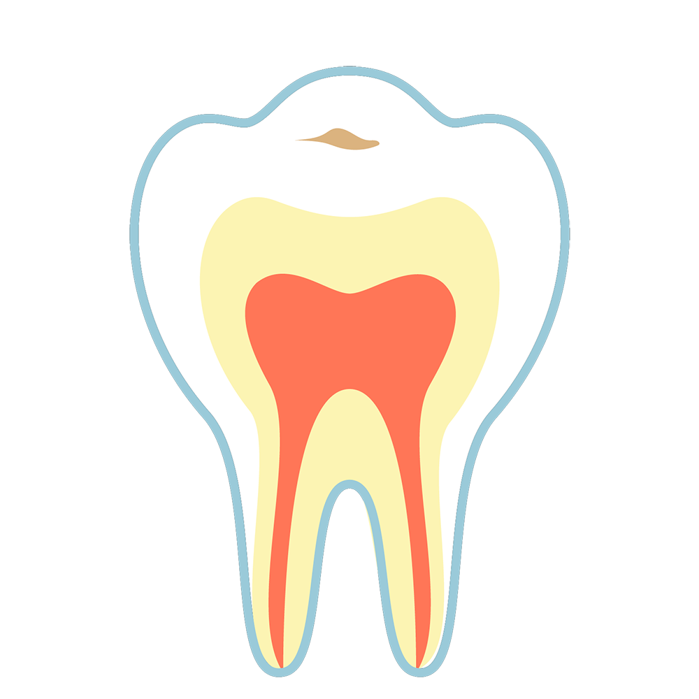 C0　歯の表面が溶かされた状態