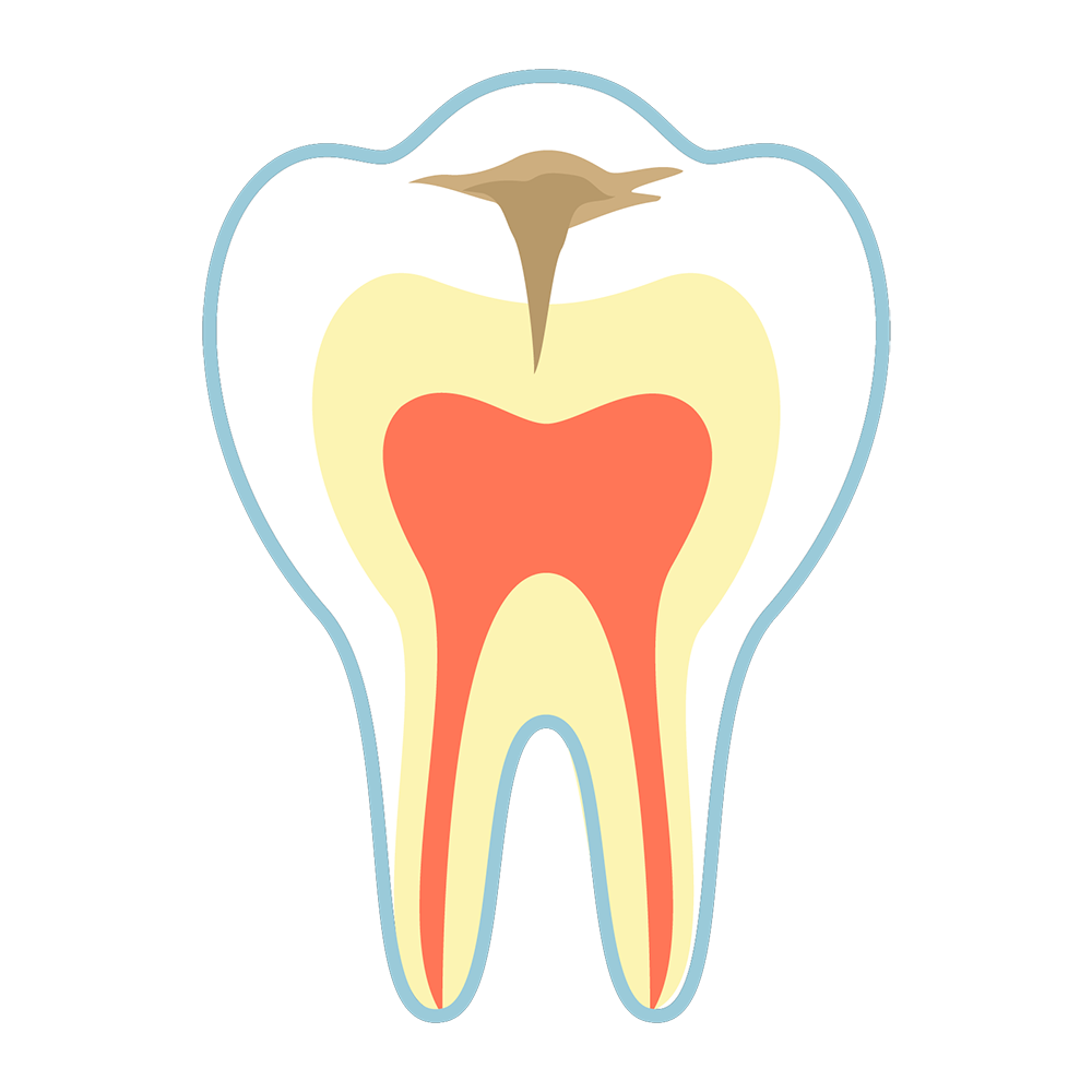 C2　歯の内部まで進んだ虫歯