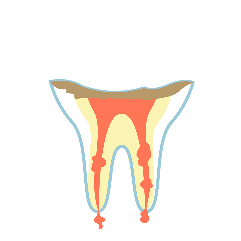C4　歯質が失われた虫歯