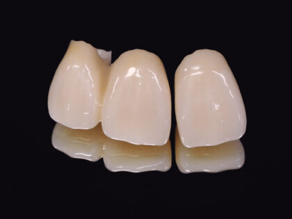 保険でできる白い被せ物「CADCAM冠」とは