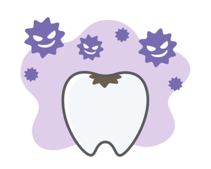 お子様のむし歯治療